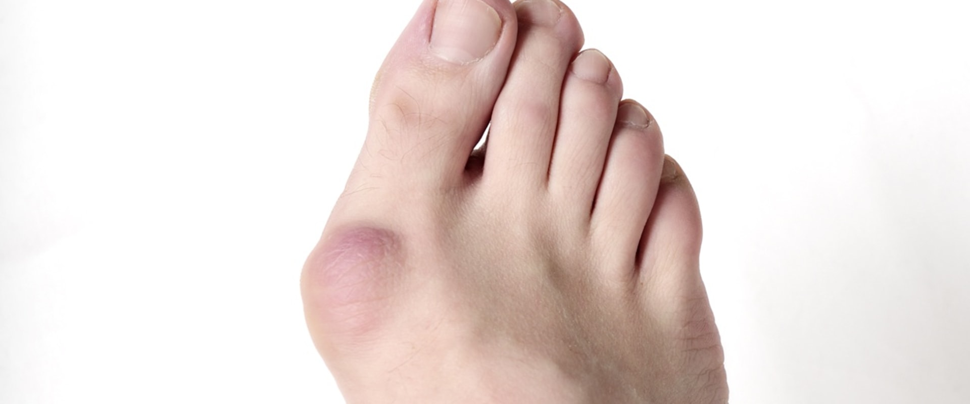 Expert Insights: Understanding the Most Painful Foot Conditions