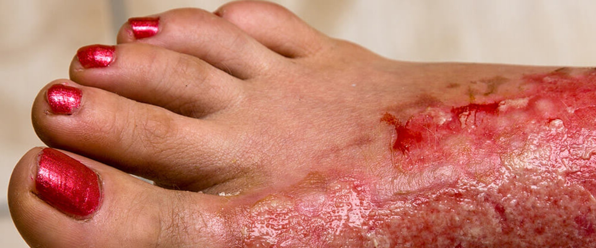 Expert Insights on Foot Injuries: Causes, Treatment, and Complications