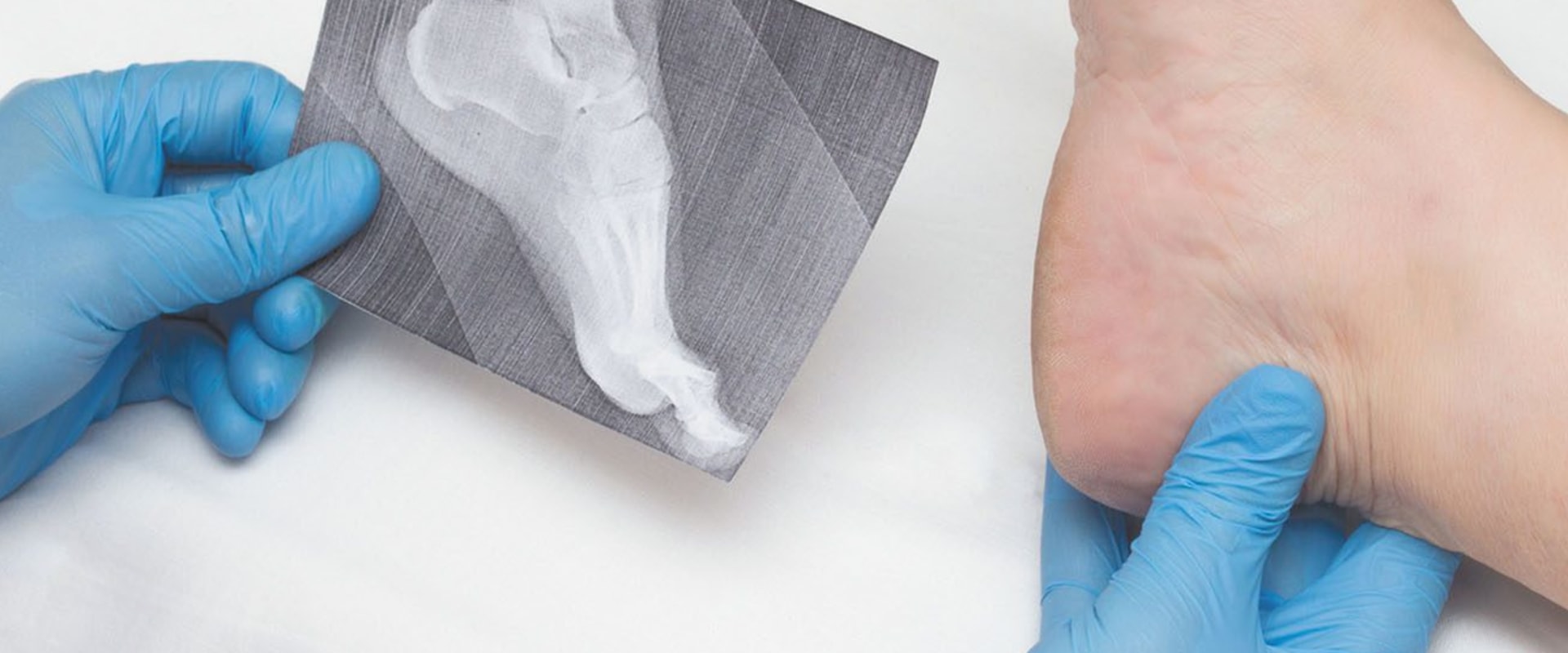 The Importance of Addressing Plantar Fasciitis