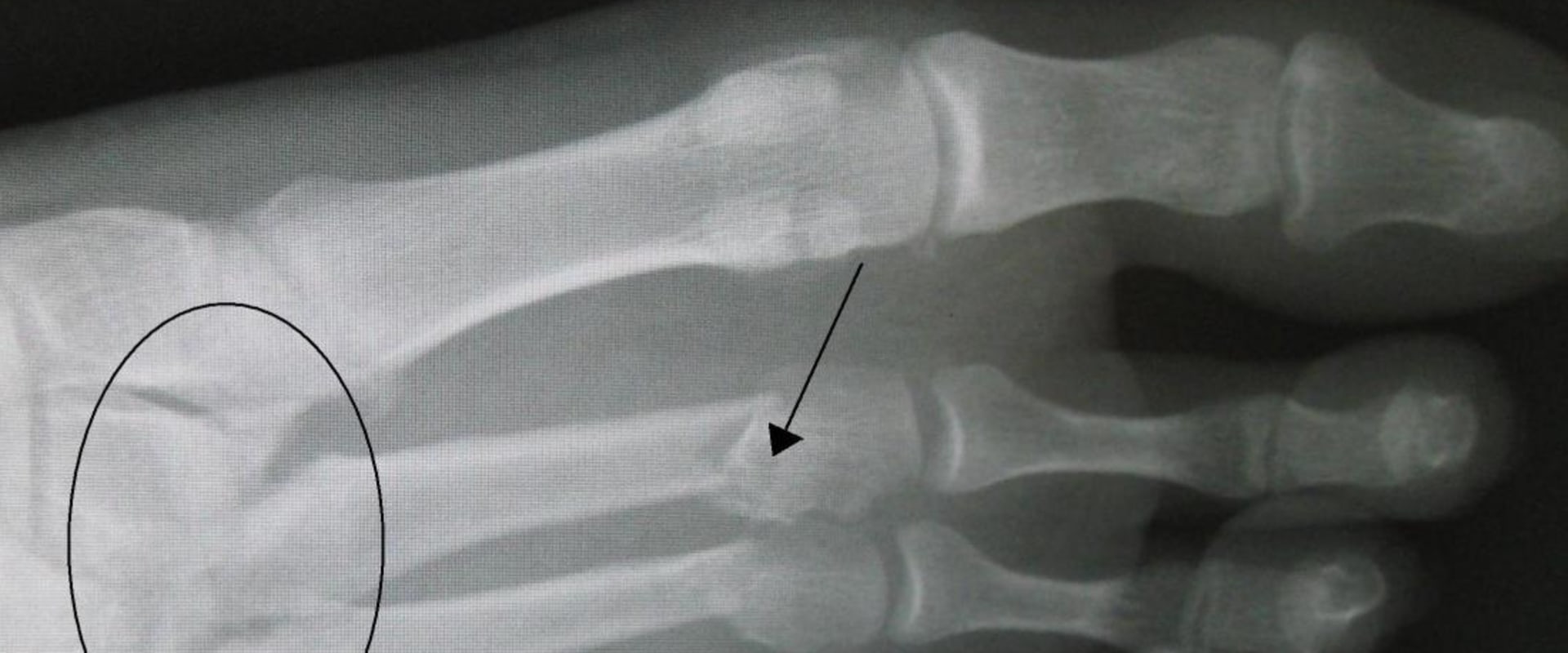 Lisfranc Injuries: What You Need to Know