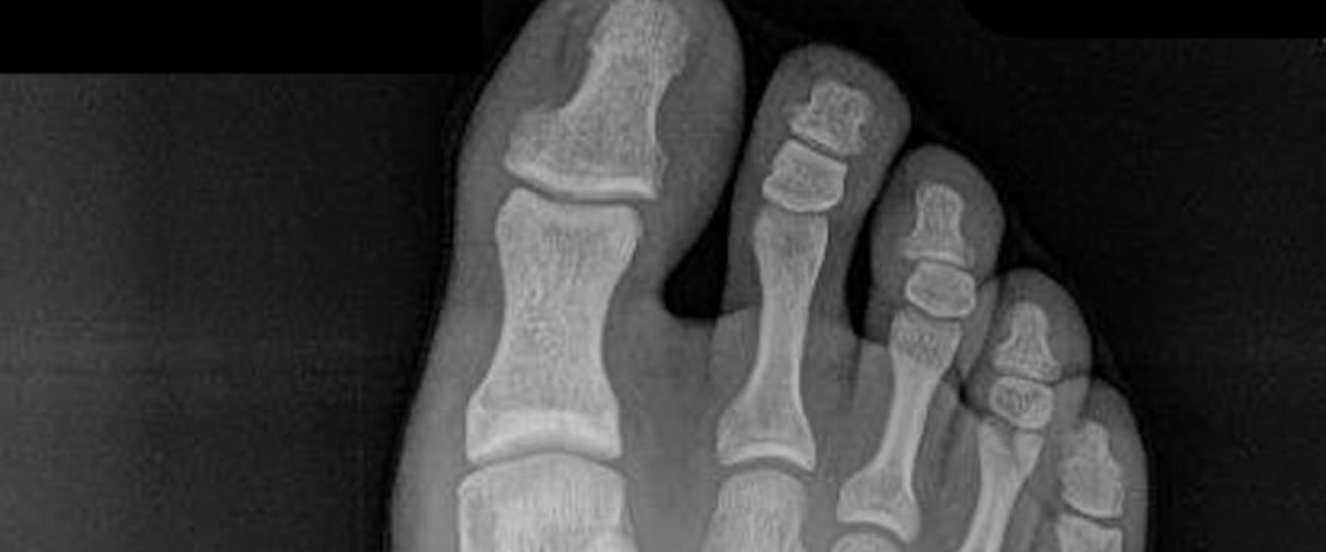 Lisfranc Fractures: What You Need to Know