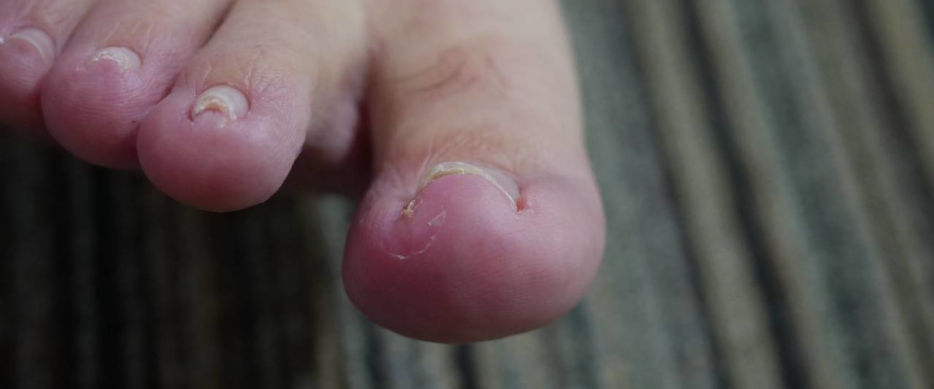 What Does an Ingrown Toenail Look Like? Identifying the Early Signs, Causes, and Effective Remedies