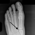 Lisfranc Fractures: What You Need to Know