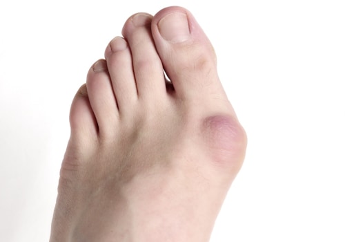 Expert Insights: Understanding the Most Painful Foot Conditions