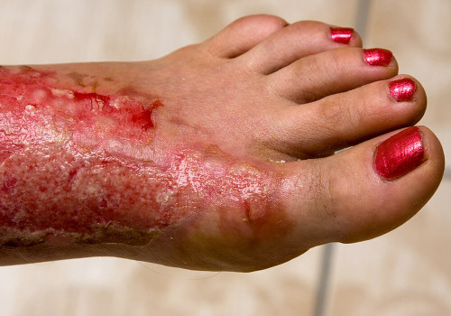 Expert Insights on Foot Injuries: Causes, Treatment, and Complications