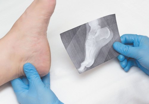 The Importance of Addressing Plantar Fasciitis