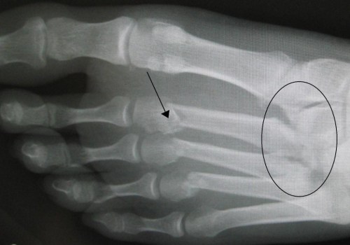 Lisfranc Injuries: What You Need to Know