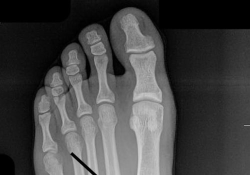 Lisfranc Fractures: What You Need to Know